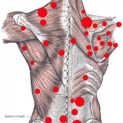 Trigger Point (Tetik Nokta) Tedavisi